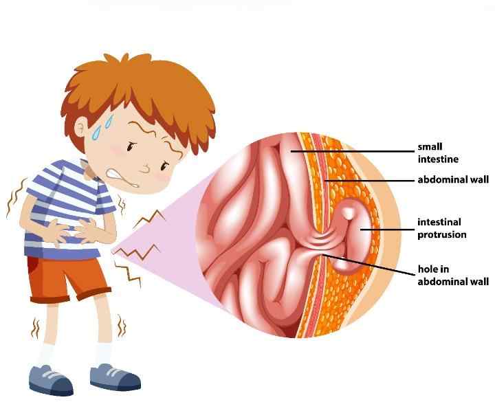 Hernia treatment surgeon