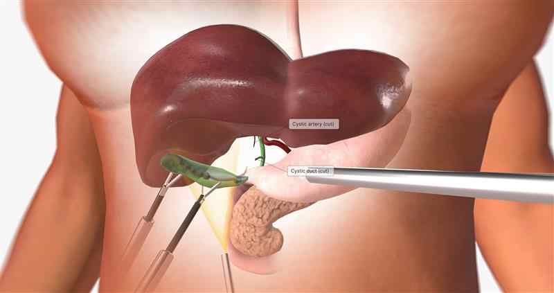 Gall bladder laparoscopic surgeon
